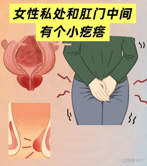女性屁眼和私处中间有个疙瘩_屁眼疙瘩莫乱治，医院检查找原因