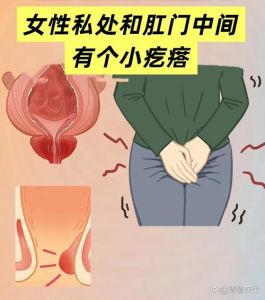 女性屁眼和私处中间有个疙瘩_屁眼疙瘩莫乱治，医院检查找原因